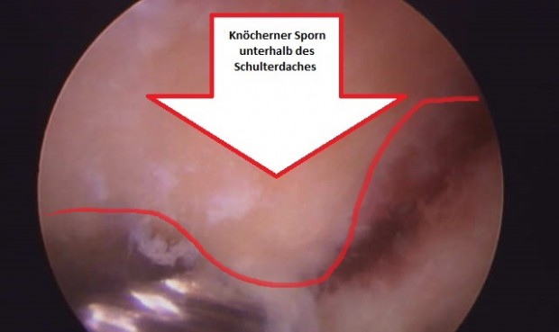 Intakter Innenmeniskus